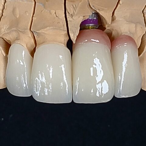 Case implant 01
