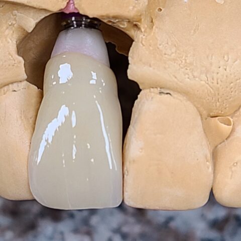 Case implant 02