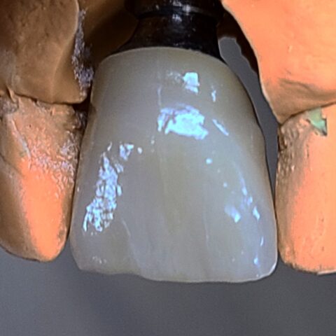 Case implant 03