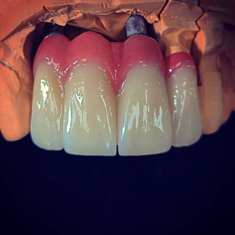 Case implant 04