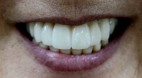 Case zirconia 01