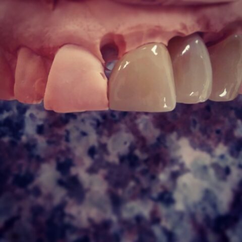 Case zirconia 02