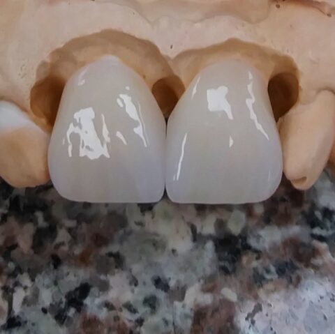 Case zirconia 03