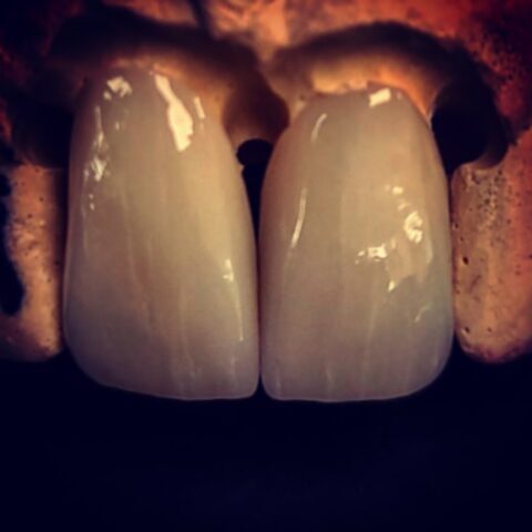 Case zirconia 04