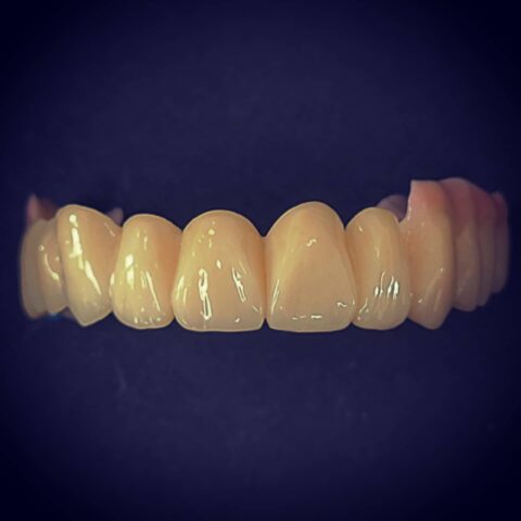 Case zirconia 05