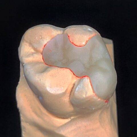 Case zirconia 06