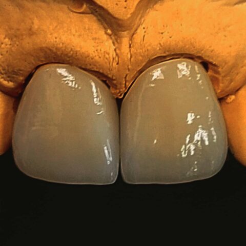 Case zirconia 08